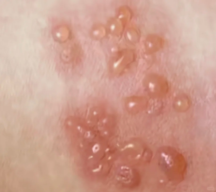 带状疱疹有哪些症状表现？南昌贡方堂中医皮肤科陈顺涛一方解毒止痛！