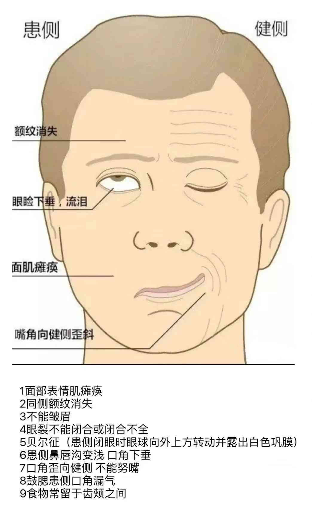 春夏面瘫高发期,新加坡贡方堂TCM中医“扶正祛邪”巧治面瘫