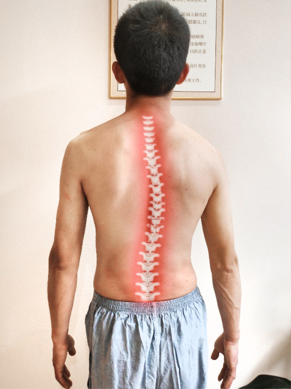 青少年脊柱侧弯可能带来的危害？新加坡贡方堂中医TCM专业体态矫正