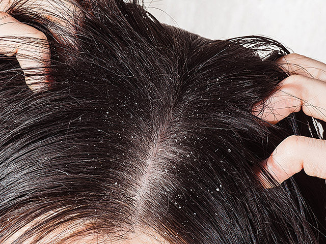 头皮瘙痒是什么原因引起的？新加坡贡方堂中医TCM陈慧芳：这是身体在“报警”