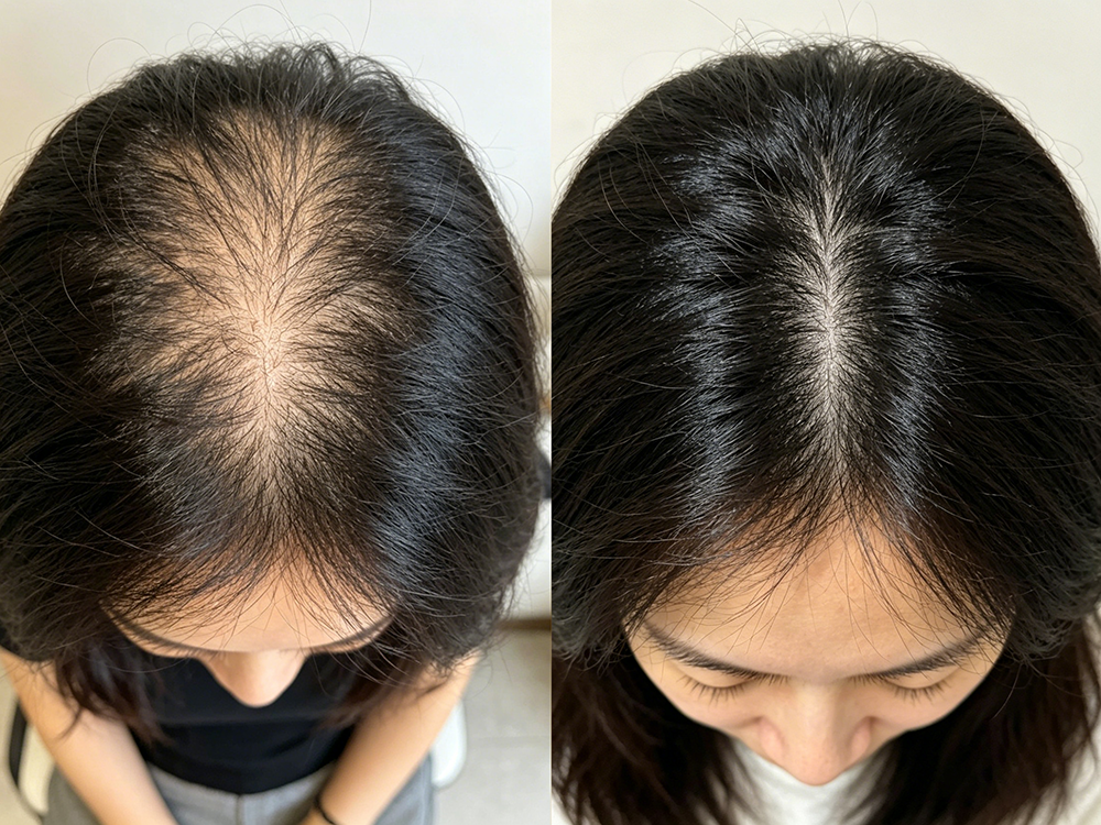 溢脂性脱发是什么原因导致的?新加坡贡方堂中医TCM陈慧芳揭秘止脱生发之道